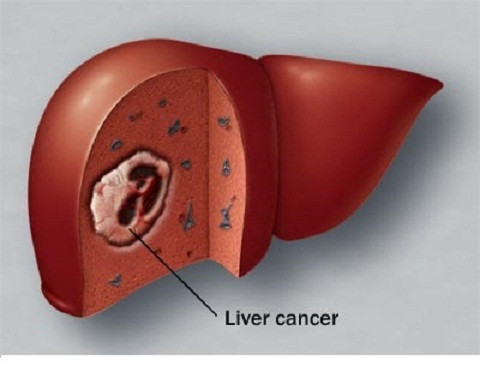 Sau đó, nếu không được phát hiện và chữa trị kịp thời, những khối u bắt đầu xuất hiện trong lá gan và to dần ra, phá hủy gan và lây lan sang bộ phận khác trong cơ thể.