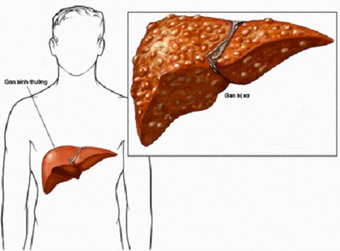 Ung thư gan được phát triển từ xơ gan. Xơ gan khiến người bệnh kém ăn, mất ngủ, buồn nôn khan, đau bụng.