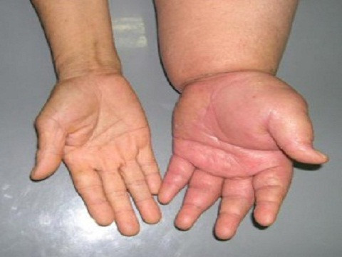 Phù nề cũng là một trong những dấu hiệu của bệnh gan. Bởi khi đó gan không thực hiện tốt chức năng của nó nữa.