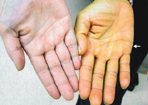 Da người bị bệnh gan (hoặc ung thư gan) sẽ vàng hơn so với người bình thường.