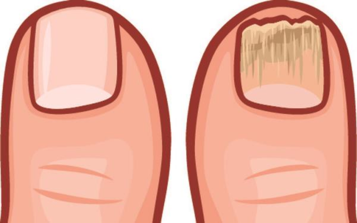 Móng chân/tay dễ gãy, rụng: Khi cơ thể bạn có nhiều độc tố, móng chân/tay của bạn sẽ trở thành môi trường thuận lợi để cho nấm và vi khuẩn cư trú và phát triển khiến móng chân/tay trở nên yếu, dễ gãy.