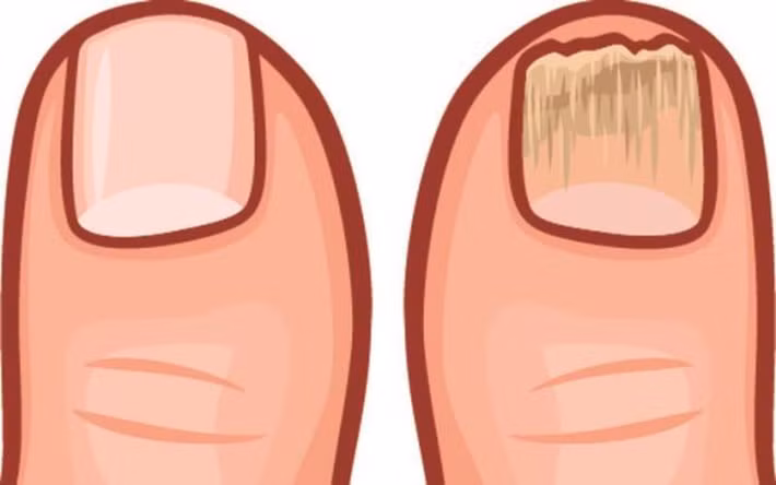 Móng chân/tay dễ gãy, rụng: Khi cơ thể bạn có nhiều độc tố, móng chân/tay của bạn sẽ trở thành môi trường thuận lợi để cho nấm và vi khuẩn cư trú và phát triển khiến móng chân/tay trở nên yếu, dễ gãy.