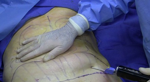 Cô gái 25 tuổi tử vong khi hút mỡ bụng: Chiều 12/4/2019, Khoa Cấp cứu, Bệnh viện Bạch Mai tiếp nhận nữ bệnh nhân Đỗ N.A từ bệnh viện An Việt chuyển đến với lý do: bệnh nhân xuất hiện co giật, trụy mạch sau khi khởi mê để phẫu thuật.