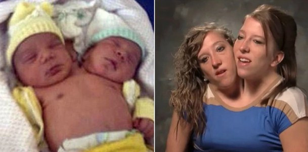 Trong các trường hợp y tế, tỷ lệ sống sót của các cặp song sinh dính liền khá thấp, thông thường có thể bị mất nhịp tim ngay từ trong bụng mẹ, tuy nhiên, một cặp song sinh dính liền ở Mỹ được các bác sĩ đánh giá là "chết sớm" lại thành công sống khỏe mạnh, vui vẻ đến tận bây giờ, khi đã 31 tuổi.