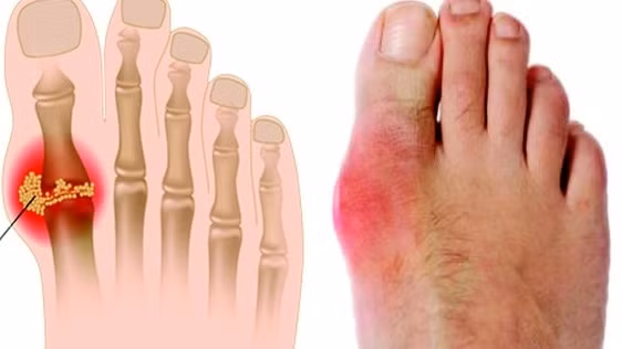 Ngày Tết, bệnh nhân gút thường bị cám dỗ từ một số thực phẩm giàu đạm hoặc bia rượu. Điều này dẫn đến những hậu quả khôn lường như máu nhiễm mỡ tăng, men gan tăng và chức năng thận giảm…Do vậy, bệnh nhân gút cần kiêng ăn một số thực phẩm Tết sau.