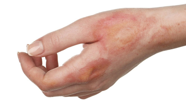 Thuốc bỏng: Trong những ngày Tết, nhu cầu nấu nướng của các gia đình đều gia tăng. Ngoài ra cũng không loại trừ một số nguy cơ bỏng do bô xe, xoong nồi nóng, than lửa,… Cho nên ngoài việc tìm hiểu cách sơ cứu cơ bản, bạn nên mua thêm các loại thuốc trị bỏng đề phòng như Pantenol dạng kem bôi hoặc dạng xịt.