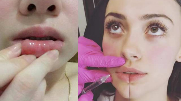 Các tác dụng phụ nghiêm trọng hơn có thể xảy ra như bầm tím hoặc sưng tấy, sưng dọc vùng tiêm, nhiễm trùng, môi lệch. Chất độn vĩnh viễn có thể gây ra các vấn đề lâu dài.