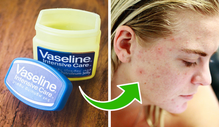 Vaseline chữa lành vết mụn trứng cá: Ngoài công dụng dưỡng môi, bạn cũng có thể sử dụng Vaseline để chữa lành vết mụn trứng cá. Nó sẽ tạo một lớp màng trên da, giúp da giữ ẩm và tự chữa lành các vết mụn. Tuy nhiên, nhược điểm của Vaseline là có thể gây bí da, bít tắc lỗ chân lông.