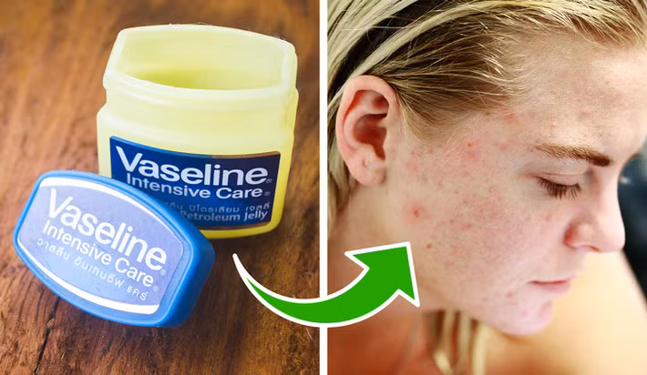 Vaseline chữa lành vết mụn trứng cá: Ngoài công dụng dưỡng môi, bạn cũng có thể sử dụng Vaseline để chữa lành vết mụn trứng cá. Nó sẽ tạo một lớp màng trên da, giúp da giữ ẩm và tự chữa lành các vết mụn. Tuy nhiên, nhược điểm của Vaseline là có thể gây bí da, bít tắc lỗ chân lông.
