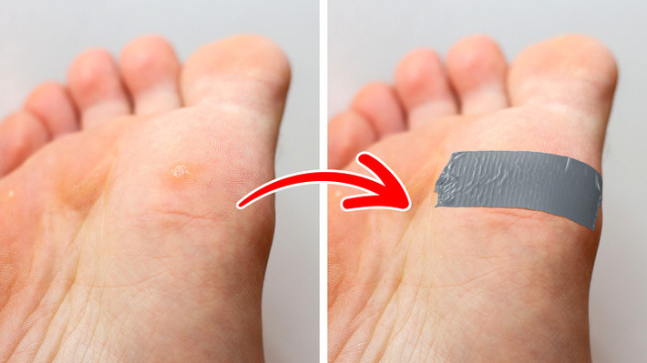 Băng keo cho mụn cóc: Khi bị mụn cóc bạn hãy vệ sinh sạch sẽ vùng da bị mụn, để khô rồi dán một miếng nhỏ băng dính che kín mụn. Sau khoảng 3 - 6 ngày bạn bóc băng dính, ngâm hoặc chườm da có mụn với nước ấm, sau đó dùng đá bọt chà nhẹ. Để da tiếp xúc với không khí qua đêm sau đó tiếp tục dán băng keo và thực hiện các bước như trên cho đến khi mụn biến mất. Ảnh: BS.