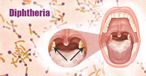 Trước đó, Mỹ từng bùng phát dịch bệnh bạch hầu quy mô lớn vào năm 1921. Khi ấy, nước này ghi nhận hơn 206.000 trường hợp mắc bệnh bạch hầu. Trong số này có hơn 15.500 người tử vong.