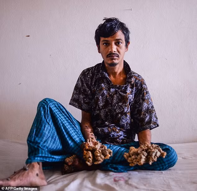 Câu chuyện về Abul Bajandar - người đàn ông với đôi tay "của quỷ" thu hút sự quan tâm của công chúng. Sinh ra và lớn lên ở Bangladesh, anh có đôi tay kỳ lạ và đáng sợ là vì mắc chứng “người cây”.