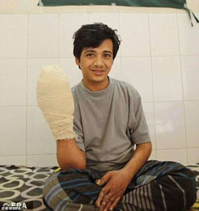 Kể từ năm 2016, Bajandar trải qua 25 ca phẫu thuật để gỡ bỏ gần 5kg “rễ cây” khỏi tay và chân.