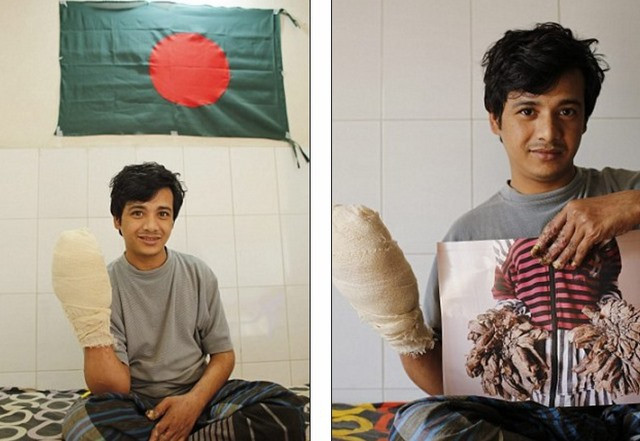 Theo chia sẻ của Bajandar, do mắc chứng "người cây" nên anh luôn cảm thấy đay đớn và không thể ngủ vào buổi tối.