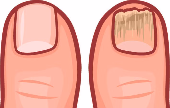 Móng chân dễ gãy và trông xấu xí: Trọng lực kéo chất độc xuống cơ thể bạn và móng chân có thể là nơi phải hứng chịu.