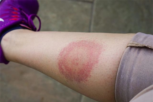Nốt ban hình mắt bò: Bệnh Lyme có thể gây ra nốt ban hình mắt bò trông giống như một vòng tròn đỏ với một vòng tròn lớn hơn bên ngoài và giữa hai vùng là da có màu bình thường. Bệnh Lyme là do vi khuẩn truyền qua ve. Nếu bạn có một dấu hiệu tương tự trên cơ thể, hãy để ý đến sốt và mệt mỏi. Ảnh: RD.