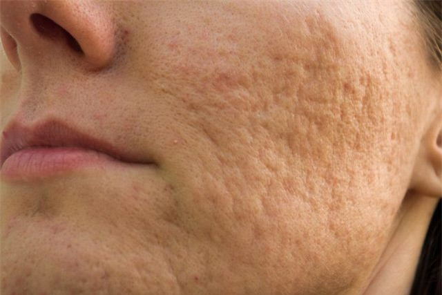 Da sần vỏ cam:Những vết lõm trên da giống như vỏ cam có thể là do các vấn đề sức khỏe khác nhau. Một trong số đó là ung thư vú dạng viêm, gây đỏ và sưng với những nốt lõm.