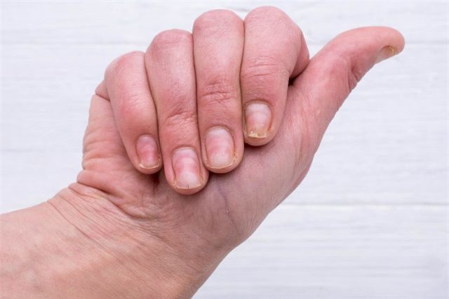 Các vết lõm trên móng tay, thường gặp ở móng tay hơn là móng chân. Chấn thương, rụng tóc hoặc bệnh vẩy nến móng có thể gây ra những vết lõm này. Bệnh nhân bị bệnh vẩy nến móng cũng có thể bị viêm khớp hoặc viêm.