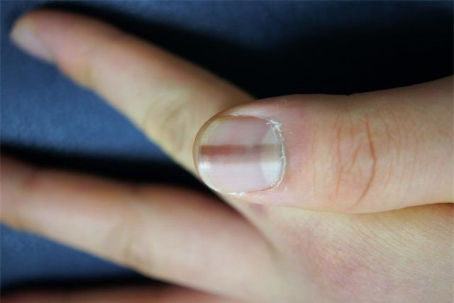 Những vệt màu nâu sẫm hoặc đen trên móng tay có thể là dấu hiệu của u ác tính dưới móng và chỉ xảy ra ở 0,7 đến 3,5% những người bị u ác tính. Các đốm khác trên móng tay cũng có thể là dấu hiệu của khối u ác tính, bao gồm cả vùng da sẫm màu quanh móng tay, máu và vết nứt trên móng.