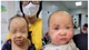 Bé 10 tháng viêm kết mạc nặng sau 1 ngày gia đình tự nhỏ thuốc