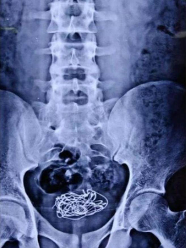 Thanh niên đau bụng dữ dội, bác sĩ khám ra điều kinh dị Thanh nien dau bung du doi, bac si kham ra dieu kinh di