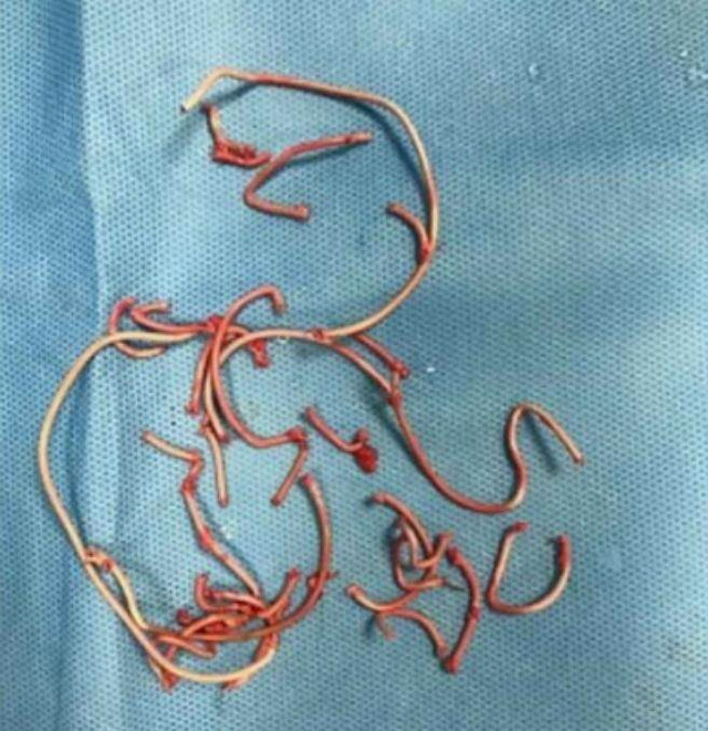 Thanh niên đau bụng dữ dội, bác sĩ khám ra điều kinh dị - Hình 2 Thanh nien dau bung du doi, bac si kham ra dieu kinh di-Hinh-2