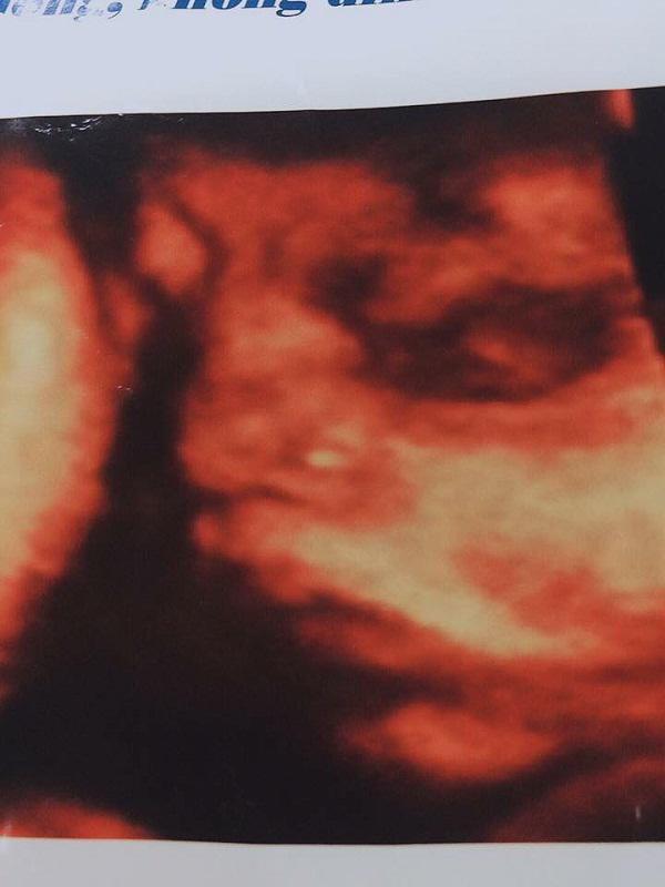 Hình ảnh con anh L. siêu âm trước khi mất. Ảnh gia đình cung cấp. Hình ảnh con anh L. siêu âm trước khi mất. Ảnh gia đình cung cấp.