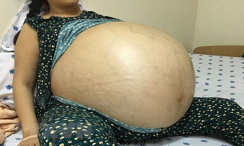 Bệnh nhân Đ.T.T với khối u khổng lồ trước phẫu thuật. (Ảnh:TTXVN/phát) Bệnh nhân Đ.T.T với khối u khổng lồ trước phẫu thuật. (Ảnh:TTXVN/phát)