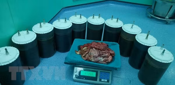 48l dịch và 3,1kg vỏ bao của khối u được các bác sỹ lấy ra khỏi cơ thể bệnh nhân Đ.T.T. (Ảnh:TTXVN/phát)