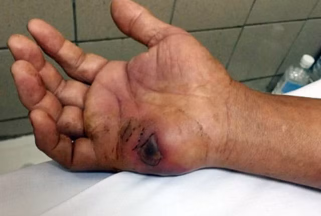 Lien tiep xay ra ran doc can nguoi, gay tu vong o Lang Son