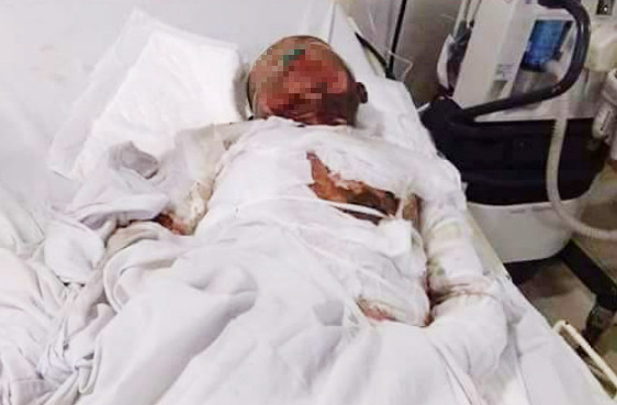 Nhay vao lua ngan vo tu tu, ca gia dinh bi bong nang