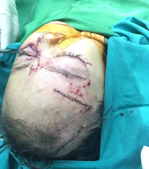 Bé gái 31 tháng tuổi bị chó nhà cắn nát mặt phải nhập viện cấp cứu Be gai 31 thang tuoi bi cho nha can nat mat phai nhap vien cap cuu