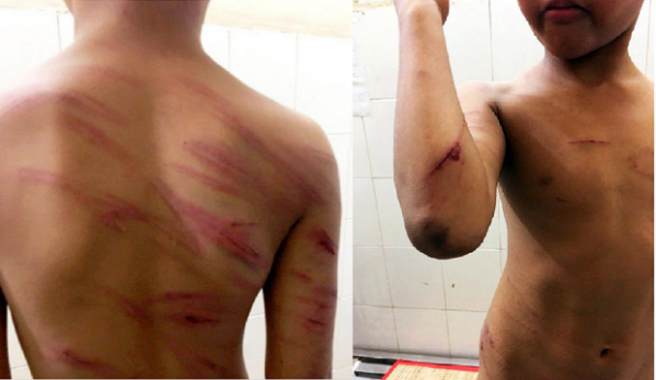 Hậu quả đau lòng từ những vụ cha dượng đánh đập con riêng - Hình 2 Hau qua dau long tu nhung vu cha duong danh dap con rieng-Hinh-2