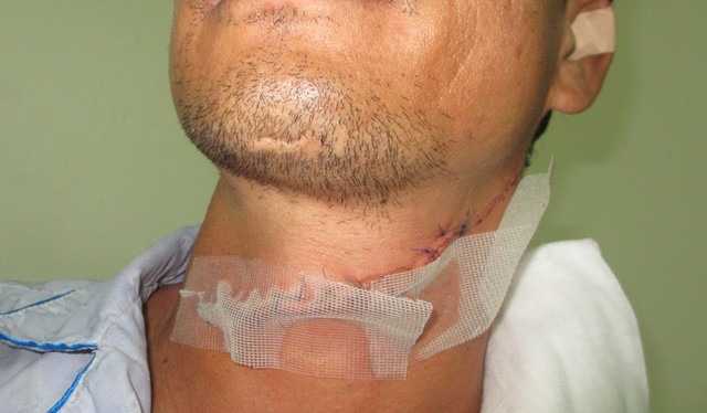 Vết cắt ở cổ ông N. phải khâu hàng chục mũi (Ảnh: Thanh Lâm).