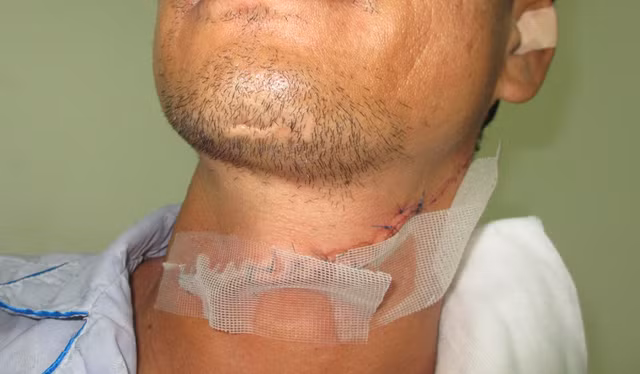 Vết cắt ở cổ ông N. phải khâu hàng chục mũi (Ảnh: Thanh Lâm).