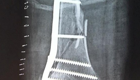 Cứu sống bệnh nhân gãy xương - tổn thương phức tạp động mạch đùi Cuu song benh nhan gay xuong - ton thuong phuc tap dong mach dui