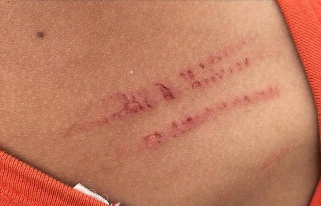 Vết xước sau khi bị mẹ kế đánh