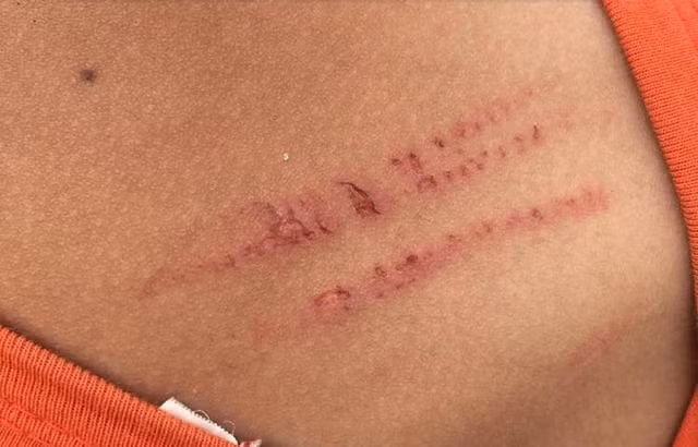 Vết xước sau khi bị mẹ kế đánh