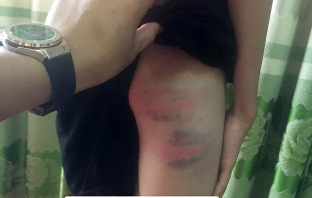 Em Tài bị bầm tím ở vùng chân Em Tài bị bầm tím ở vùng chân