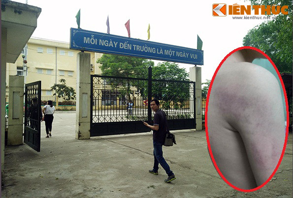 Theo Hiệu trưởng nhà trường thì cháu T. bị cô giáo đánh thâm tím vai (ảnh nhỏ) trong lớp học. Theo Hiệu trưởng nhà trường thì cháu T. bị cô giáo đánh thâm tím vai (ảnh nhỏ) trong lớp học.