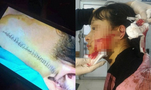 Khuôn mặt của nữ sinh P.L bị rạch dài 14cm, sâu 0,5cm. Khuôn mặt của nữ sinh P.L bị rạch dài 14cm, sâu 0,5cm.