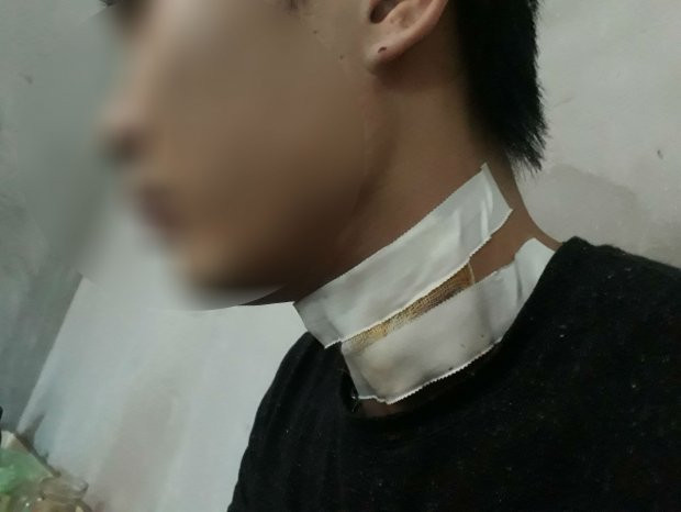 Anh T. phải khâu nhiều mũi sau pha cứa cổ của hai thanh niên. Nguồn ảnh: Zing Anh T. phải khâu nhiều mũi sau pha cứa cổ của hai thanh niên. Nguồn ảnh: Zing