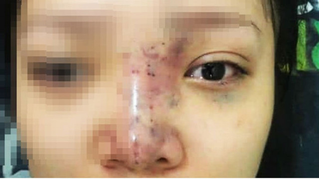 Công an vào cuộc vụ spa tiêm filler làm nữ sinh 20 tuổi mù mắt Cong an vao cuoc vu spa tiem filler lam nu sinh 20 tuoi mu mat