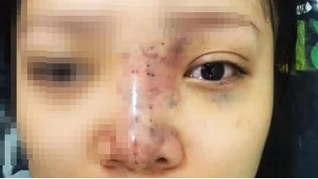 Cong an vao cuoc vu spa tiem filler lam nu sinh 20 tuoi mu mat