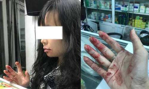 Chị Linh bị tài xế Uber đánh chảy máu mồm. Chị Linh bị tài xế Uber đánh chảy máu mồm.