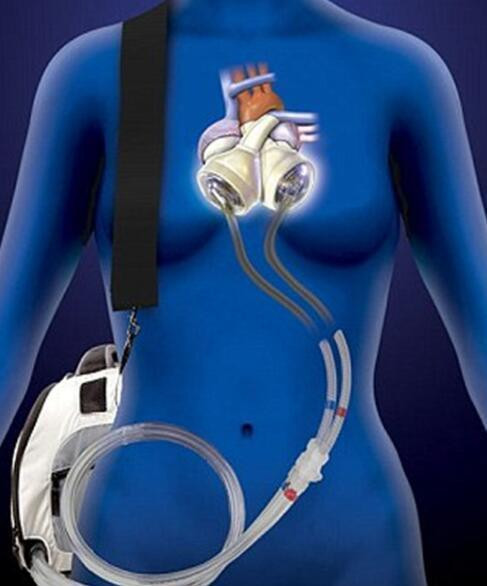 Thông thường, các bệnh nhân dùng trái tim nhân tạo sẽ không rời khỏi giường bệnh thế nhưng Marshall thì khác. Cảm nhận được cuộc sống quá quý giá, còn quá nhiều chuyện muốn làm, Marshall quyết định sẽ đeo trái tim nhân tạo trên lưng, tìm kiếm sự tự do.