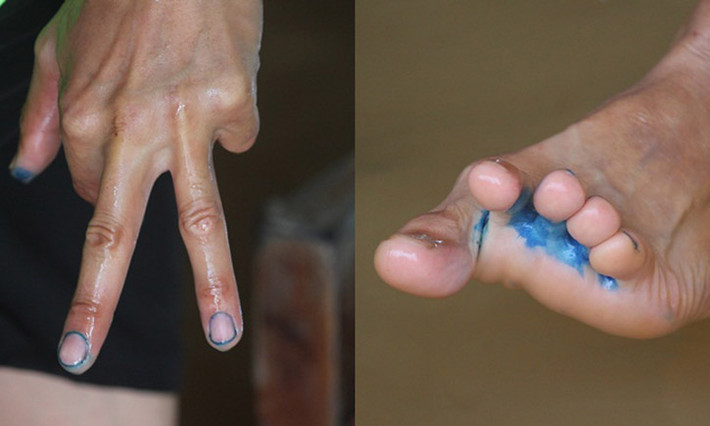 Chân, tay của người dân bị nước ăn do thường xuyên phải lội trong nước lũ.