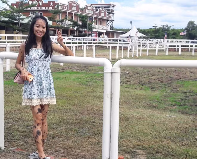 Kể từ đó, 9X cố gắng phớt lờ mọi ánh mắt dò xét, bình luận thô lỗ, tiêu cực về làn da, không cãi lại những người chỉ trích vì Evita cho rằng bất cứ ai cũng không xứng đáng để chỉ trích khiếm khuyết trên cơ thể cô.