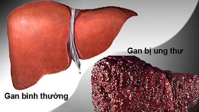 Ung thư gan có thể di căn tới nhiều cơ quan trên cơ thể.