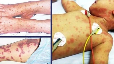 Trẻ em là đối tượng dễ mắc não mô cầu